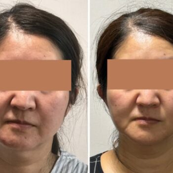顎変形症手術 顔の変化　アラ50
